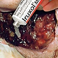 Iruxol (Smith & Nephew)