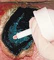 Intrasite gel (Smith & Nephew)